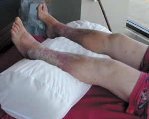 Conforming Comfort® Venous Stasis Device